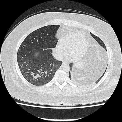 Chemotherapy During Active SARS-CoV2 Infection: A Case Report and Review of the Literature